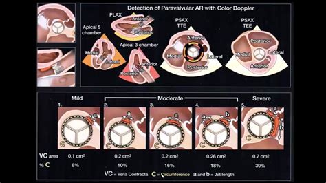 Echocardiographic Assessment Of Prosthetic Valves Youtube