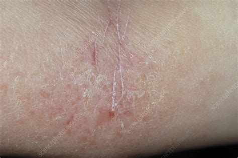 Atopic Eczema In A Child Stock Image C0051844 Science Photo Library
