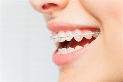 Orthodontist In Mt Pleasant Sc What You Should Know About Ceramic Braces