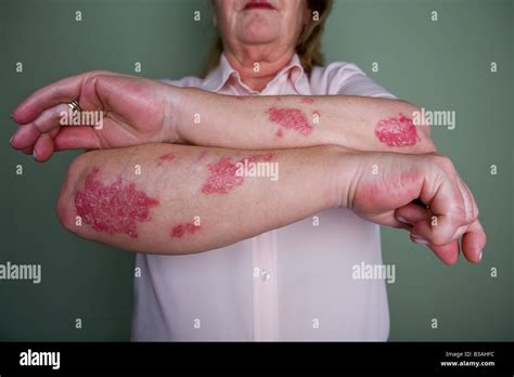 Erythematous Skin Plaque Hi Res Stock Photography And Images Alamy