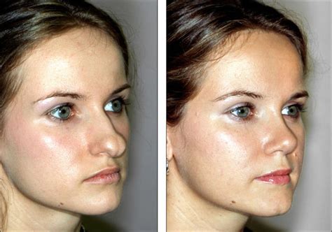 Nose Job Before And After Female Big Nose