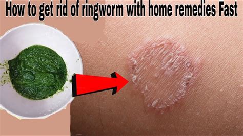 How To Get Rid Of Ringworm With Home Remedies Fast Ringworm Treatment