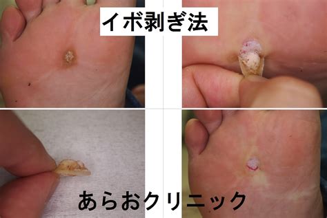 イボ剥ぎ法（ウイルス性イボの治療） 横浜市青葉区の美容皮膚科・形成外科あらおクリニック