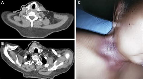 The Neck Ct Scan Showed Multiple Metastatic Cervical Lymph Nodes
