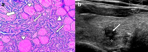Ultrasound Findings Of Papillary Thyroid Microcarcinoma A Review Of
