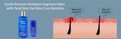 How To Get Rid Of Ingrown Hair Causes And Treatment Ingrown Hair