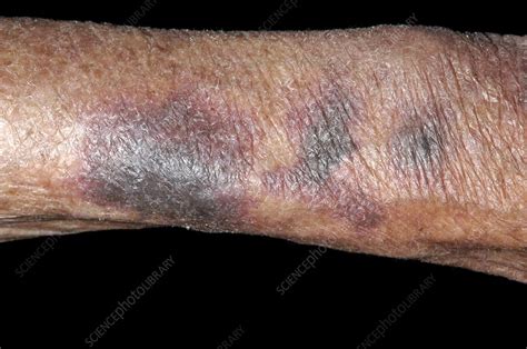 Bruising Of Arm From Aspirin Stock Image C0051930 Science Photo