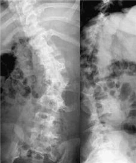 Preoperative Anteroposterior And Lateral Radiographs Demonstrating