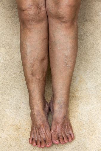 Varicose Veins On Legs With Feet In Senior Woman Stock