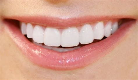Porcelain Veneers For A Perfect Smile Healthy B Daily