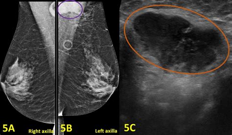 Cureus Cat Scratch Disease Is An Entity Often Diagnosed In Breast