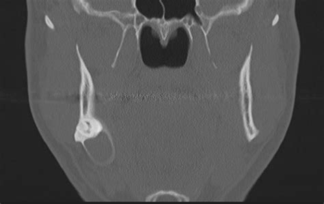 Dentigerous Cyst Image