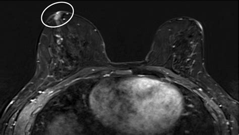 An Analysis Of Nipple Enhancement At Breast MRI With Radiologic