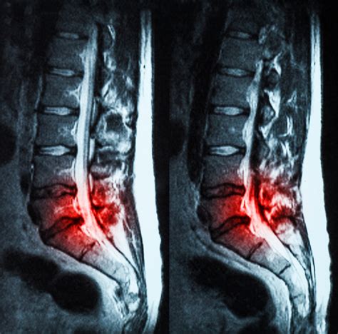 Symptoms Of Severe Spinal Stenosis Of L4 L5 Premia Spine