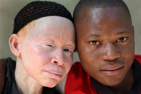 Thanks To Witchcraft Albinos Face “extinction” In Malawi Un Expert Says Terry Firma