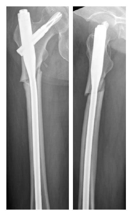 Radiographs From Case Examples With Atypical Subtrochanteric Femoral