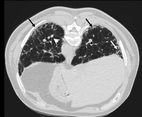 Predominantly Lower Lobe And Subpleural Reticulation White Arrows