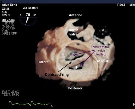 A Novel 3d Echocardiographic Rendering Tool For Assessment Of Mitral