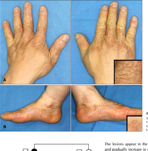 Figure 1 From A Case Of Focal Acral Hyperkeratosis Semantic Scholar