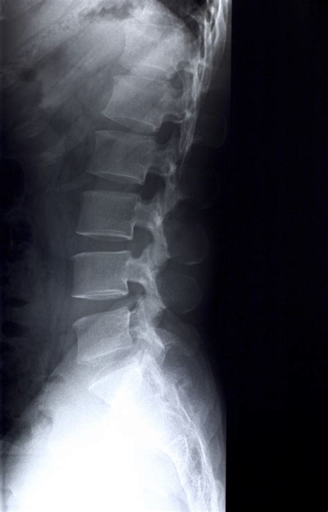 Lumbar Spine X Ray Lumbar Spine Positioning