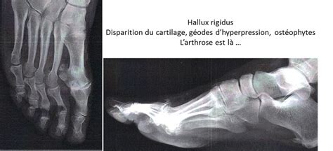 ARTHROSE ORTEIL Dr Rémi chirurgien orthopédiste à Toulouse