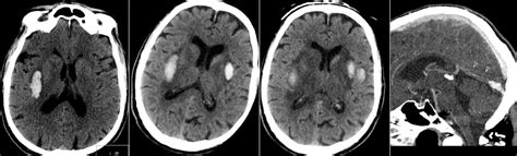Radiology Mri Deep Cerebral Venous Sinus Thrombosis With External
