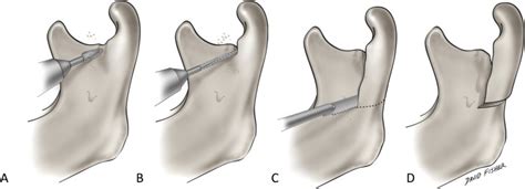 Intraoral Vertico Sagittal Ramus Osteotomy Modification Of The L