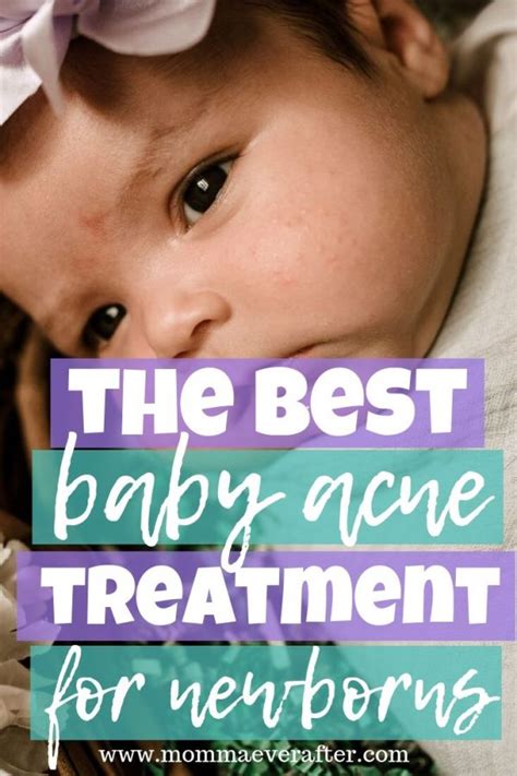 The Best Baby Acne Treatment For Newborns Momma Ever After