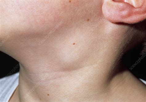 Close Up Of Swollen Lymph Node In The Neck Of Boy Stock Image M200