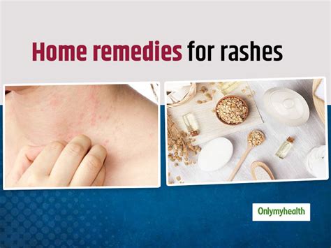 Want To Treat Rashes On Skin Here Are 7 Effective Home Remedies To Get Rid Of Them Naturally
