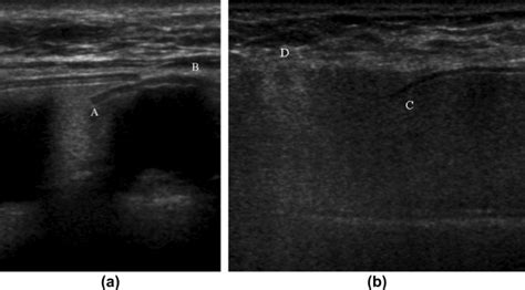 The Sonographic Appearances Of Breast Implant Rupture Clinical Radiology