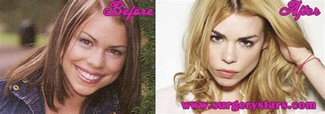 Billie Piper Plastic Surgery Before And After Photos