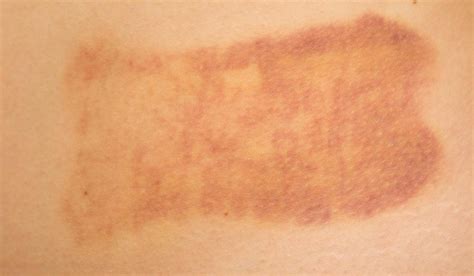 Skin Cancer Cancer Skin Discoloration