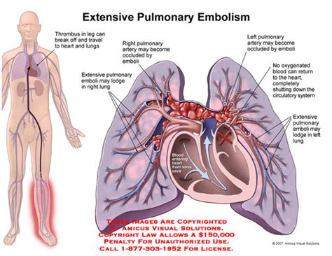 Amicus Illustration Of Amicus Injury Dvt Vein Thrombosis Thrombus Embolism Pulmonary Emboli