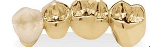 Questions to Consider About Your Dental Gold - Chicago Gold Gallery