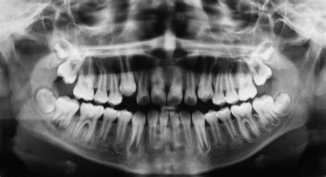 Radiografía Panorámica Costa Rica Sonrisa Para Todos Dentistas
