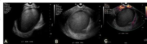 Figure From Sonographic Features Of Tubo Ovarian Abscess Mimicking An