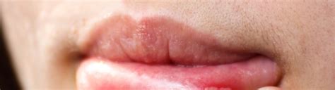 What Causes Lip Canker Sores Smart Tips