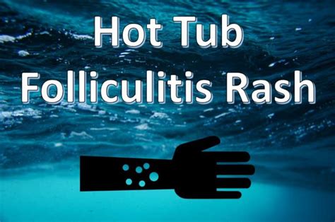 What Is Hot Tub Folliculitis Rash 7 Ways To Treat It