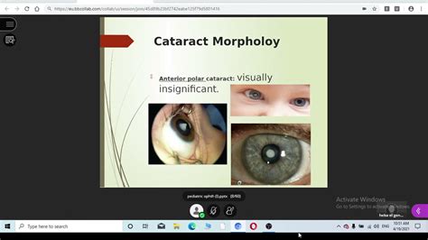 Pediatric Ophthalmology 2 Youtube