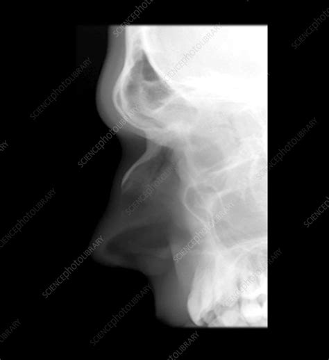 X Ray Of Face Showing Nasal Bones Stock Image P120 0207 Science