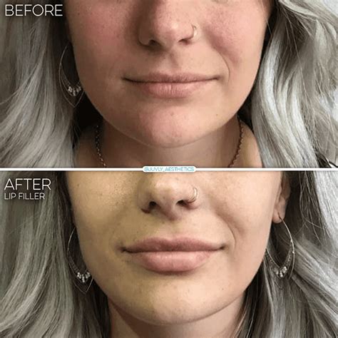 Subtle Lip Filler Before And After