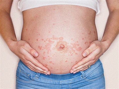 7 Types Of Pregnancy Rash Symptoms And What They Look Like