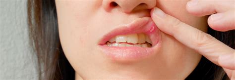 Best Canker Sore Treatment In India Mouth Sore Cure Near Me