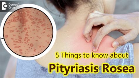 Things To Know About Pityriasis Rosea Pityriasis Rosea Rash Dr