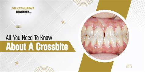 All You Need To Know About A Crossbite