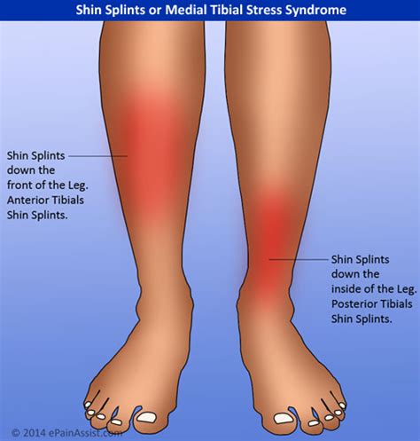 Shin Splints Shinbone Pain And Treatment Brace