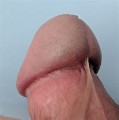 Frenulum Breve Or Phimosis Please Help Images Attached Penis