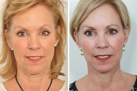 Top Celebrity Face Lift Surgeon Natural Looking Facelift For Women In