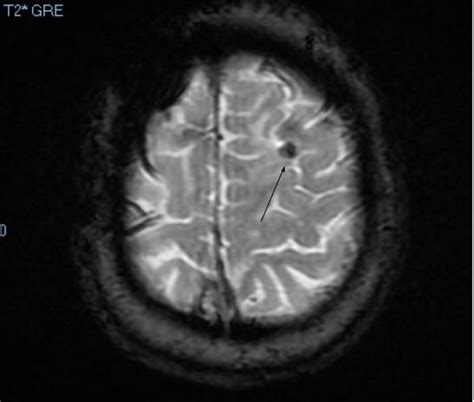Cureus Bone Fragment Granuloma Mimicking A Brain Tumor Following